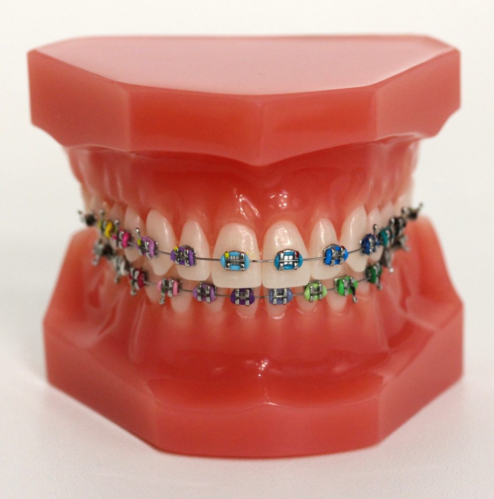 метални брекети