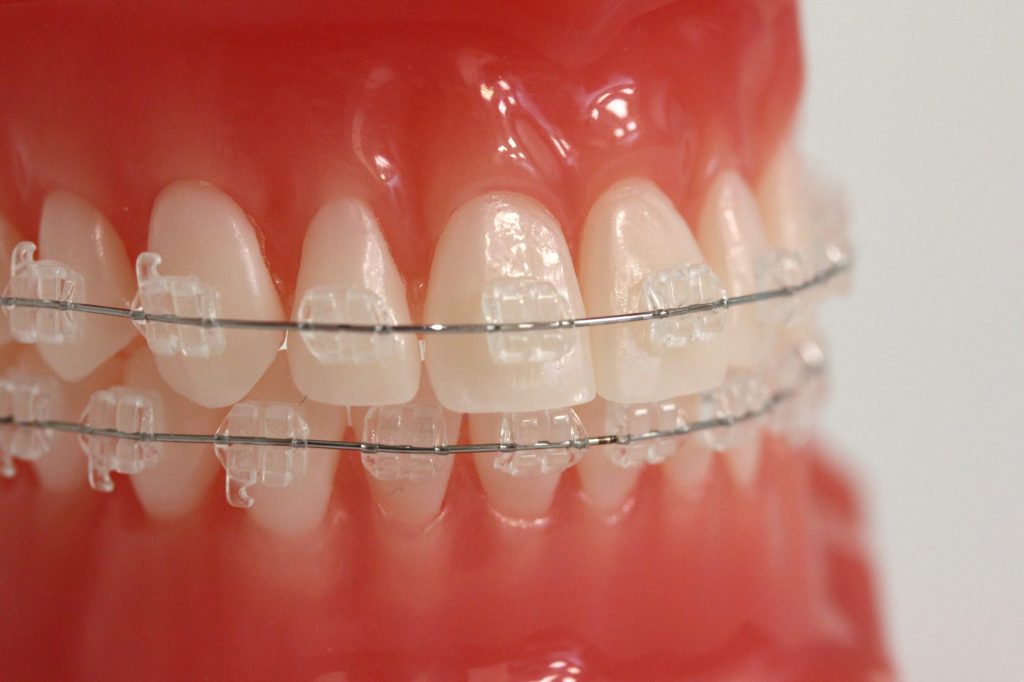 сапфирени естетични брекети