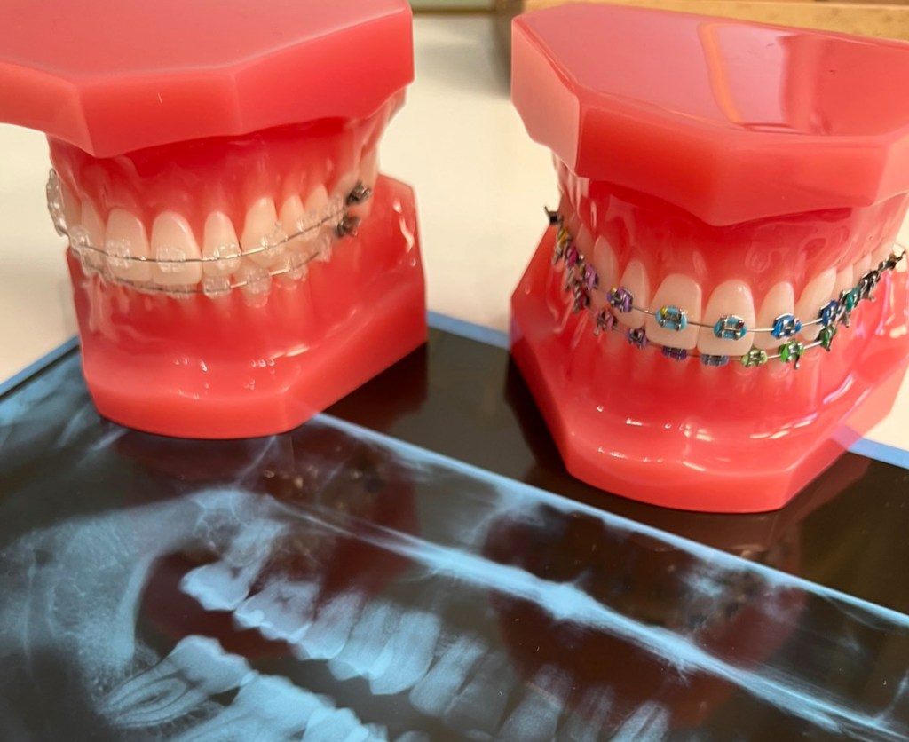 Ортодонтско лечение за&nbsp;възрастни