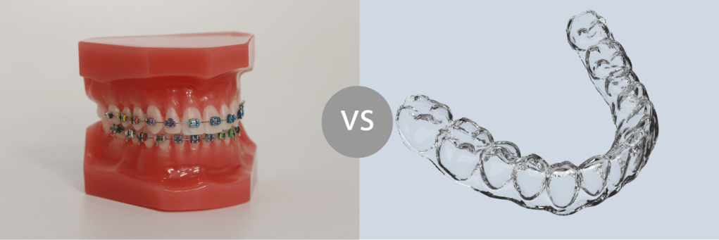 Брекети или Алайнери